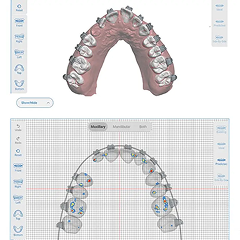 KLOwen Custom Braces