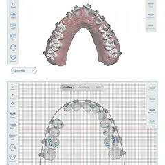 KLOwen Custom Braces